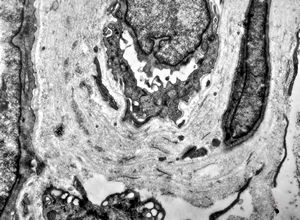 F, 48y. | lupus erythematodes … multiplicated vascular basement membrane